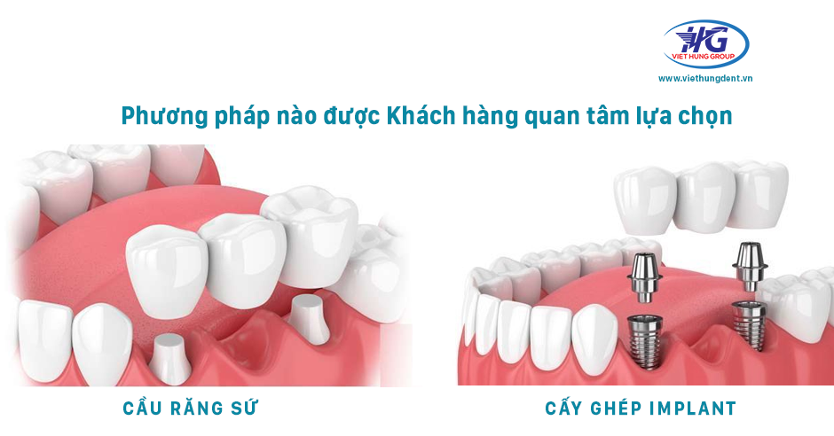 Khác biệt giữa răng Implant và cầu răng sứ