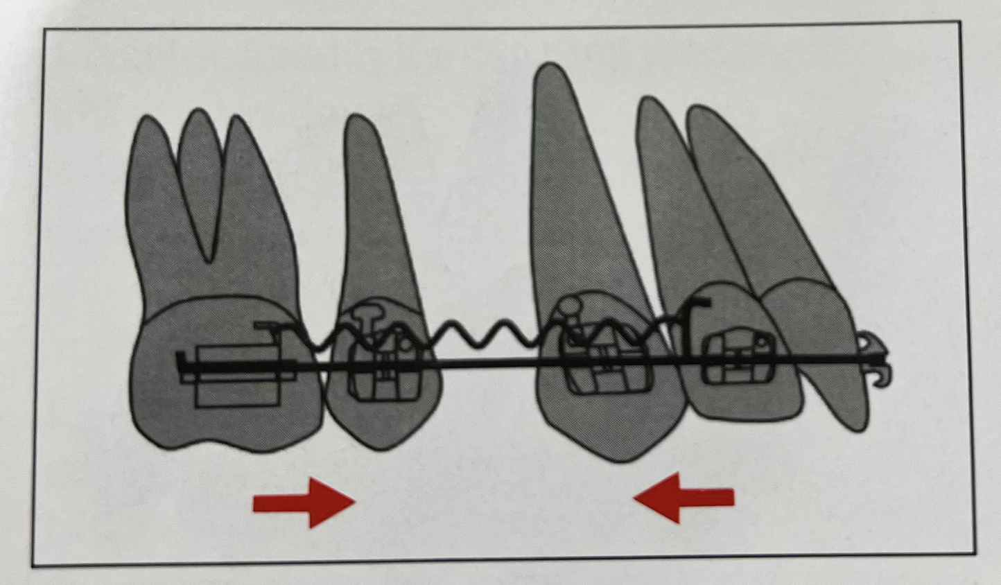 Kéo lùi khối răng với cơ học ma sát, dây cung trượt qua các mắc cài và ống của các răng
