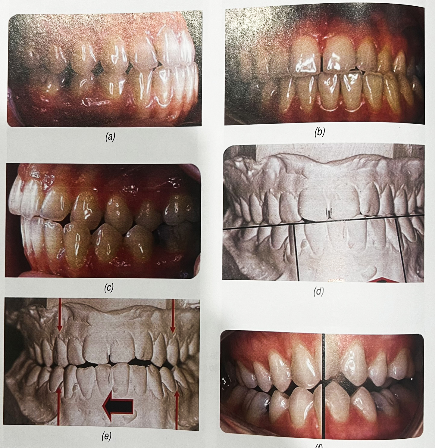 Nong hàm một bên trường hợp bất đối xứng theo chiều ngang - Cắm minivis xương ổ răng