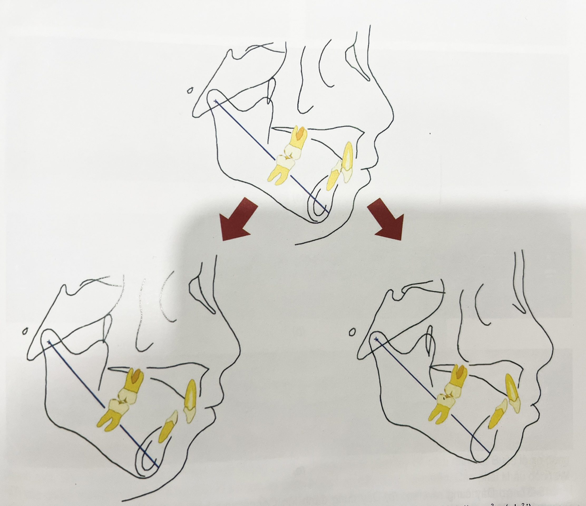 Thay đổi của hàm dưới sau khi làm trồi răng hàm (trái) hoặc đánh lún răng cửa (phải)