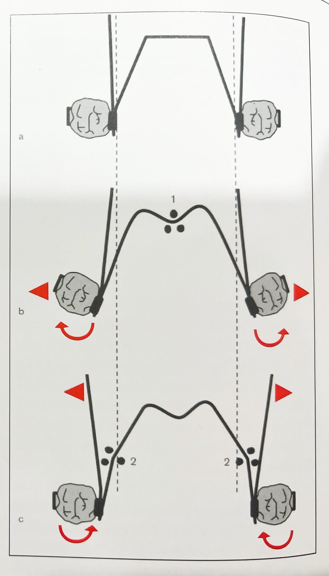 Điều chỉnh cắn chéo bằng Quad helix