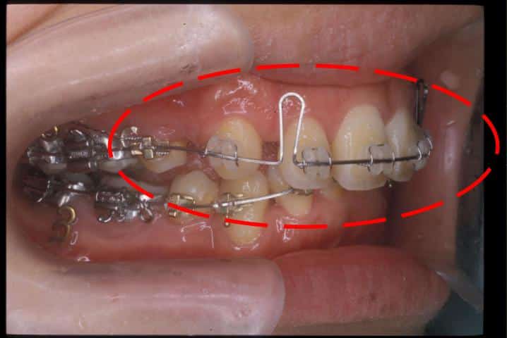 Đóng khoảng nha với hệ thống không ma sát bằng loop