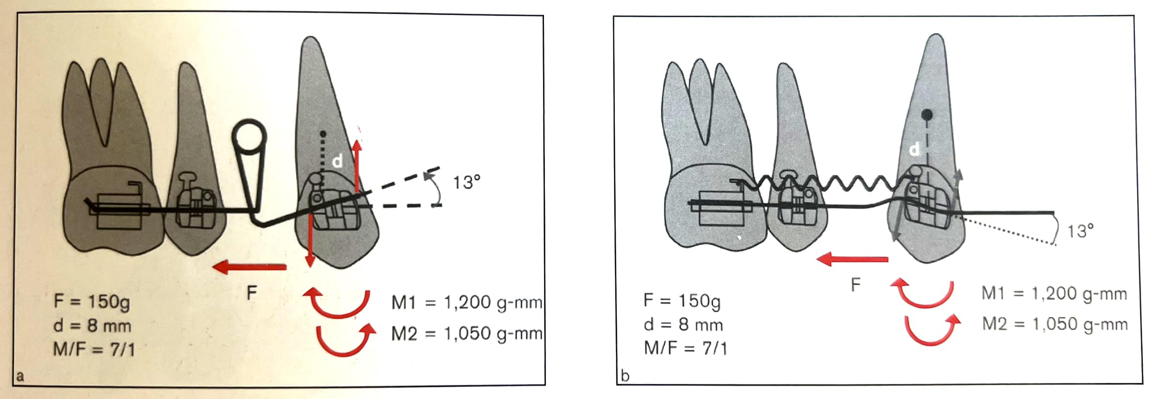 Bẻ dây cung (a) Cơ học edgewise tiêu chuẩn; (b) Cơ học dây thẳng