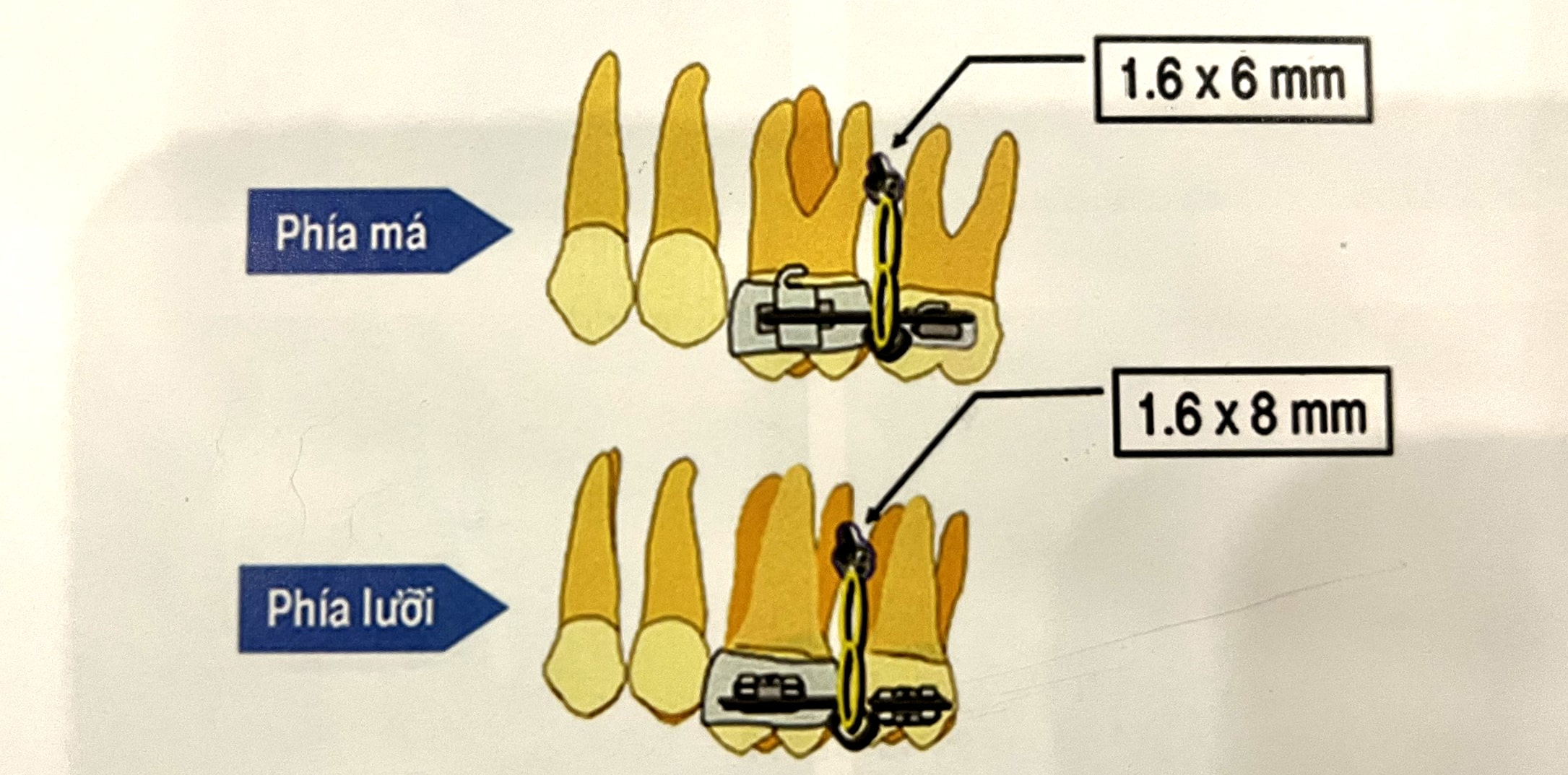 Ứng dụng hai minivis để đánh lún hai răng liền kề