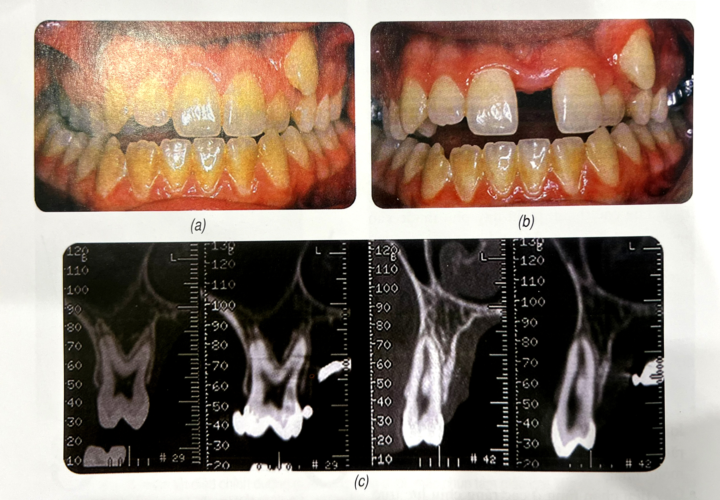 (a,b) Ảnh chụp miệng trước và sau nong hàm (c) Phim CT trước nong hàm