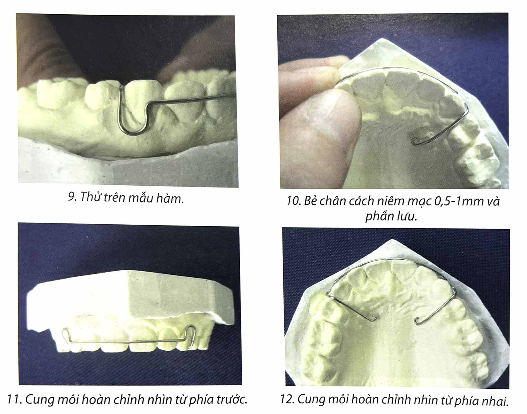 Cách bẻ cung môi bằng kềm chỉnh nha