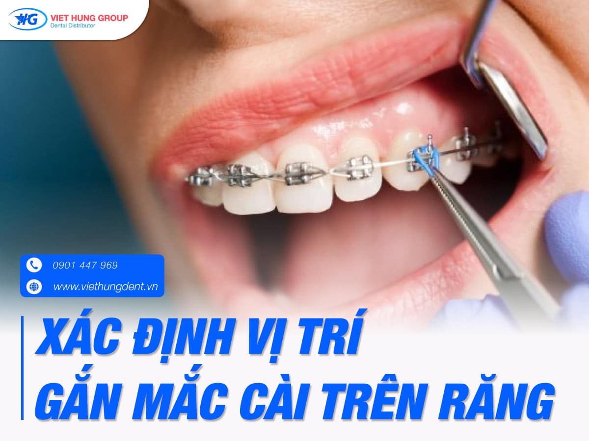 xác định vị trí mắc cài trên răng